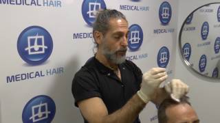 ¿Cómo se aplica el minoxidil Detener la caída del pelo [upl. by Whitford]