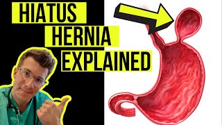 Everything you need to know about a HIATUS HERNIA  Causes symptoms diagnosis amp treatment [upl. by Reyna]