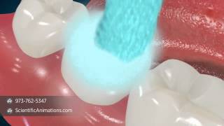 Dental Sealants  Tooth Decay Treatment [upl. by Fernas]