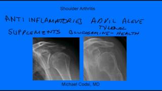 Shoulder arthritis [upl. by Ahsil780]