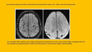 NEUROLOGY QUIZ 69 Cerebral Amyloid Angiopathy CAA [upl. by Gretna243]