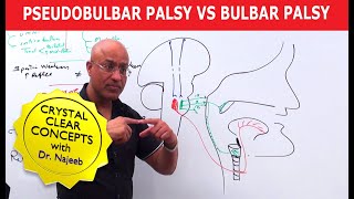 Pseudobulbar Palsy vs Bulbar Palsy [upl. by Brunhilda591]