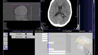 CT Scan of brain work process [upl. by Adnorehs]