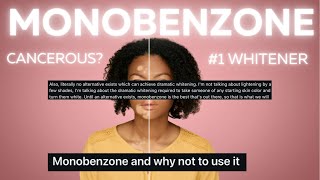 Monobenzone Why and Why Not To Use It  Alternatives [upl. by Psyche270]