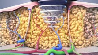 non surgical lipo animation [upl. by Assilac]