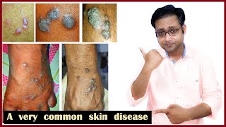 Lichen planus treatment  Hindi [upl. by Fulviah]