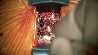 Cervical Disc Replacement with MobiC for Treatment of Cervical Disc Herniation [upl. by Llednov]