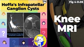 Fig 4D06 Hoffa’s Fat Pad Ganglion Cysts [upl. by Kelwunn]
