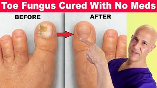 Toe Nail Fungus Cured With No Meds Dr Mandell [upl. by Drescher]