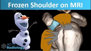 How Frozen shoulder looks on MRI [upl. by Bellanca]