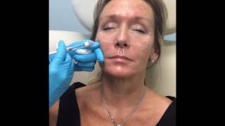 Restylane Lyft Cheek Enhancement [upl. by Westfall]