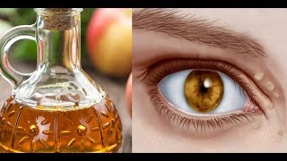 Natural Remedies to Cure Xanthelasma or Cholesterol Deposits Around the Eyes [upl. by Anidan]