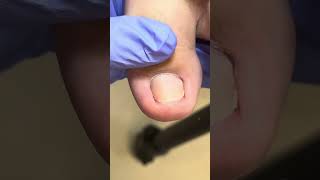 Trimming ingrown toenails and removing dirt from them【Dr Lius Pedicur Branches】pedicure nails [upl. by Reppep]