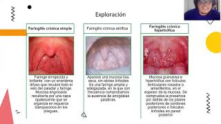 Faringitis Crónica [upl. by Prisca]