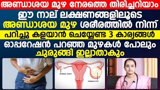 അണ്ഡാശയ മുഴ ഓപ്പറേഷൻ കൂടാതെ കുറക്കാൻ ചെയ്യേണ്ട 3 കാര്യങ്ങൾ [upl. by Gilchrist381]