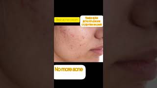 duac acne gel before and afterbest acne treatment by dermatologistacnetreatment trendingvideo [upl. by Aicilaana]