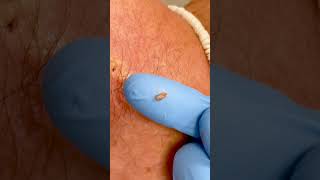 shorts Blackhead Squeezed Out  CONTOUR DERMATOLOGY [upl. by Hallee]