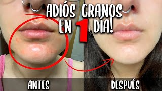 ▶ Cómo ELIMINAR GRANOS en 1 DÍA Árbol del té vs Irritación por mascarilla 😷 ◀ [upl. by Aninaig]