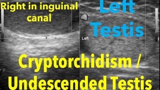 Undescended testis or Cryptorchidism [upl. by Lindberg]