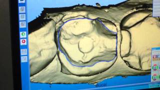 Diseño de incrustación en sistema CADCAM Cerec Godín Odontolgía Cali valle [upl. by Alduino]