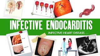 Infective Endocarditis  Dukes criteria  definition causes symptoms complications amp treatment [upl. by Furey]