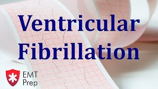 Ventricular Fibrillation ECG  EMTprepcom [upl. by Cliff]