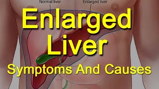 Enlarged Liver Symptoms And Causes  What Is Hepatomegaly [upl. by Elehcim258]