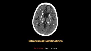 Intracranial Calcifications Causes  1000 cases in 100 days  21000 [upl. by Segalman]