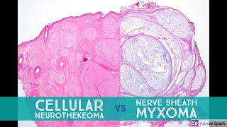 Cellular Neurothekeoma vs Nerve Sheath Myxoma  Dermpath Lookalikes [upl. by Shwalb]