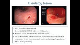 Dieulafoys Lesions  Definition causes Diagnosis Treatment Complications [upl. by Gertrude]