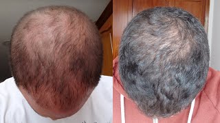 RECUPERACIÓN de CABELLO SIN TRASPLANTE CAPILAR  Caso real SUSCRIPTOR [upl. by Leshia405]