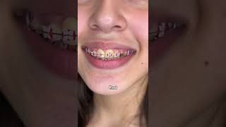 Braces Colors Before and after 8 weeks [upl. by Tychon]