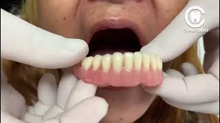 DENTAL PROSTHESIS without ACRYLIC on the LIP 😱😱😱 [upl. by Zsuedat]