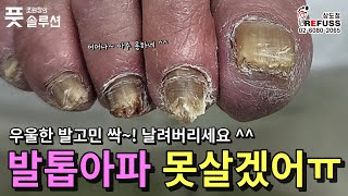 발톱아파 우울한 90대 어르신의 오랜 발고민 속시원한 발톱 관리후 재주가 용하다고 칭찬해 주셨습니다 조원장의풋솔루션 레푸스상도점 문제성발관리 refuss 서울레푸스 [upl. by Clercq199]