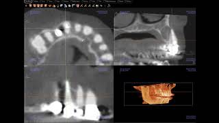 Periapical cyst radicular cyst confirmed [upl. by Kline]