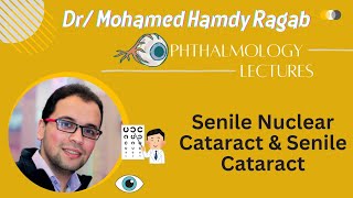 Lens 3 Senile Nuclear Cataract amp Senile Cataract management [upl. by Mourant]