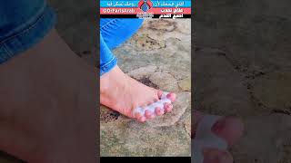 فوائد موزع اصابع القدم  علاج الوكعة bunions  halluxvalgus [upl. by Ellinnet37]