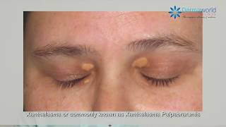 What is Xanthelasma   Dr Rohit Batra explains [upl. by Nonnahc]