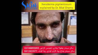 Xeroderma pigmentosum  skin cancer  best dermatologist  Dr Syed Bilal Shams skincenterpakistan [upl. by Fabron]