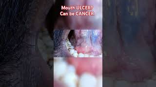 NON healing ulcer can be CANCER [upl. by Armstrong136]