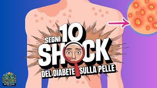 ALLARME Pelle 10 Segnali NASCOSTI del Diabete che Devi Conoscere ORA [upl. by Luttrell]