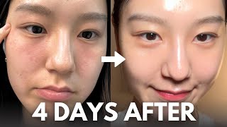 How I repair my skin barrier in 4 days at home with affordable skincare routine [upl. by Xirtaeb]