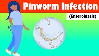 Pinworm Infection Enterobiasis  Causes Signs amp Symptoms Treatment [upl. by Ennahoj312]