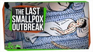 The Last Major Smallpox Outbreak in America [upl. by Nyrak767]