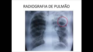 Curso de Radiologia de Tórax Aula V [upl. by Daryle]