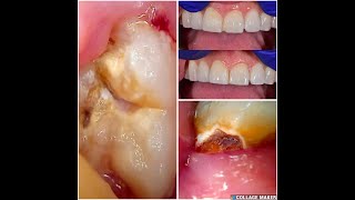 62 Chipped front tooth repair and wisdom teeth extractions [upl. by Laerol901]