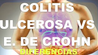 Colitis Ulcerosa vs Enfermedad de Crohn Comparación [upl. by Collimore]