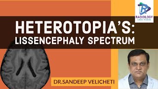 HeterotopiasLissencephaly SpectrumSandeep velichetiLissencephaly spectrum type 1 part2ped neuro [upl. by Acirderf]