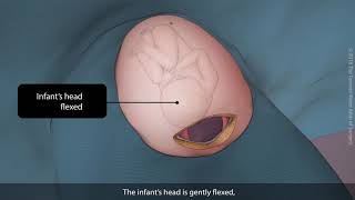 Primary vertex caesarean section Csection  TVASurg [upl. by Aivekal]