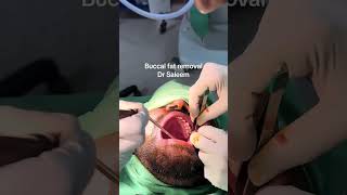 Buccal fat removal in Pakistan lahore [upl. by Margarette]